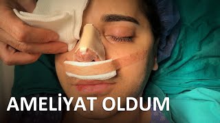 AMELİYAT OLDUM  BURNUMU NASIL KESTİLER [upl. by Alieka]