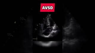 Atrioventricular septal defect  congenital heart defect echocardiography AVSD [upl. by Ilac192]