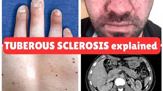 Tuberous Sclerosis Complex TSC Recognizing Adenoma Sebaceum and Other Clinical Signs [upl. by Nirihs]