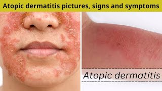 Atopic dermatitis pictures signs and symptoms  Nuse Healthy [upl. by Gayle]