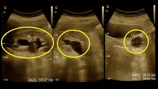 Grade  3  Hydroureteronephrosis  Ultrasound  Report  Amader hospital  Ultrasonography report [upl. by Aidas]