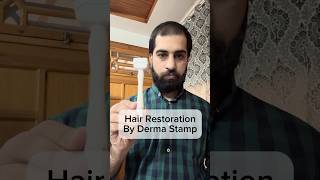 Hair Restoration using Derma Stamp hairlosstreatment regrowhairline [upl. by Nevile]