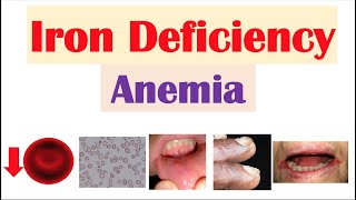 IronDeficiency Anemia Overview  Causes Pathophysiology Signs amp Symptoms Diagnosis Treatment [upl. by Esyak480]