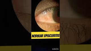 Nodular Episcleritis nodularepiscleritis eyediseases [upl. by Ibok]