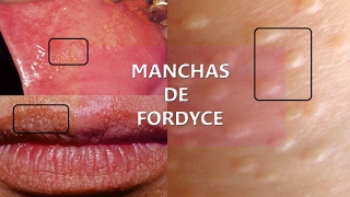 Manchas de Fordyce una confusión con VPH [upl. by Shelba]