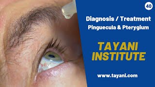 Pinguecula amp Pterygium Diagnosis  Tayani Institute [upl. by Imhskal577]