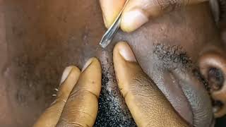 ASMR SQUEEZING OUT  REMOVAL OF LONG INGROWN HAIRS IN BEARD beard care [upl. by Silvers427]