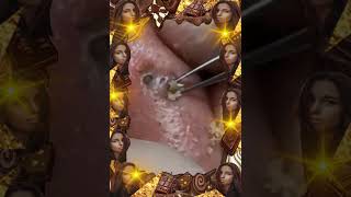 Blackheads Removal  Acne Treatment and Very Satisfying Satisfying Pimple pop blackheads [upl. by Kermit535]