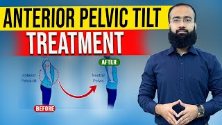 Get Rid Of Anterior Pelvic Tilt Fast With Easy Home Remedies [upl. by Nahtad]