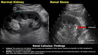 Renal Stone Kidney Ureter amp Bladder KUB Ultrasound Report Example  Renal Calculus USG Scan [upl. by Eintihw]