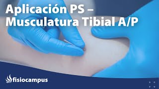 punción seca del tibial anterior y posteriorr [upl. by Nayrbo]