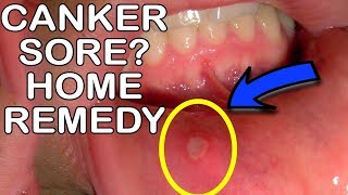 How To Get Rid Of Canker Sores Mouth Ulcer Home Remedy [upl. by Ecirtel]