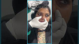 Under Eye Filler Before and After  Best Techniques Revealed  AWISH Clinic [upl. by Surat673]