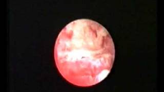 hysteroscopic treatment of osteoid metaplasia [upl. by Norvell]