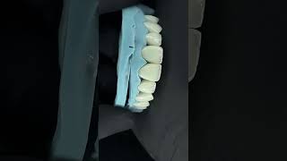 Crowns lithium disillicate ceramotion lisi incisal cut back layered with porcelain ceramotion Zr [upl. by Grier]