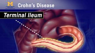 IBD School 102  What is Crohns Disease [upl. by Armando]