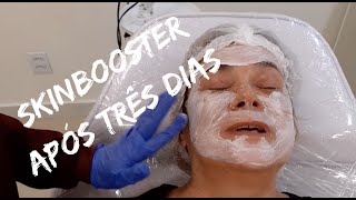 SKINBOOSTER APÓS TRÊS DIAS DE APLICAÇÃO  COMO ESTA MINHA PELE [upl. by Nnylasor]