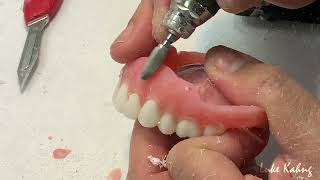 Loose Denture Relining [upl. by Helenka554]