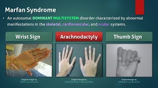 Marfan Syndrome [upl. by Eserehc]