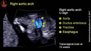 Fetal echocardiography at 1113 weeks Right Aortic Arch RAA [upl. by Ardnazil]