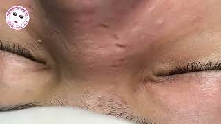 Acne facial removal treatment by Sopheaskincarecambodia 29 August 2023 [upl. by Sine]