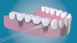 TePe Bridge amp Implant Floss  für die Reinigung um die Implantate [upl. by Nyleimaj]