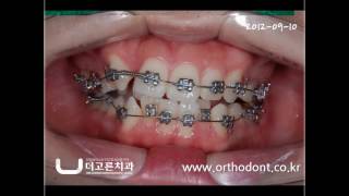 교정치료의 시작과 끝 그리고 유지 1 Beginning ending and maintenance of orthodontic treatment 1 [upl. by Sadirah]