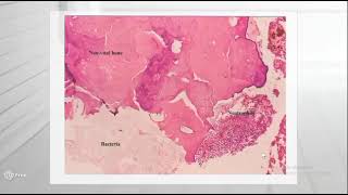 Osteomyelitis Part 2 [upl. by Werbel]