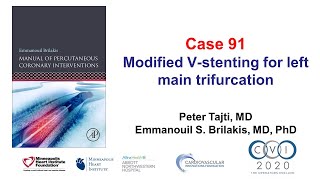 Case 91 PCI Manual  Left main trifurcation [upl. by Dorry944]