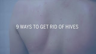 9 Ways to Get Rid of Hives  Health [upl. by Rossy]