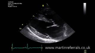 Normal echo in a dog long axis view [upl. by Ekard]