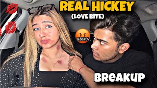 Real Hickey Love Bite 💋 Prank On Anmol  He Got Extremely Angry 🤬 [upl. by Shanon]