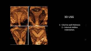 Mullerian duct anomalies  a simplified explanation [upl. by Melodee]