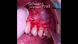 Enucleation of a Glandular Odontogenic Cyst [upl. by Cleave]