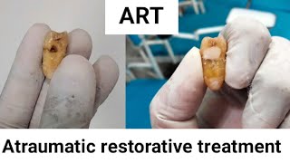 Atraumatic restorative treatment session community dentistry [upl. by Pejsach]