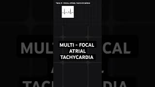 multifocal atrial tachycardia  ECG basics [upl. by Vala]