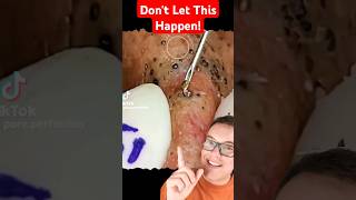 Record Dark BLACKHEADS REMOVAL  Dont Let This Happen shorts [upl. by Bedell]