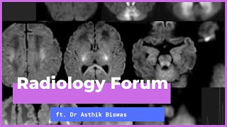 Common Paediatric Neurometabolic Disorders  Early Imaging Recognition by Dr Asthik Biswas [upl. by Arahset]