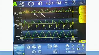 Assessment of Respiratory Drive in Ventilated Patient Using P01 [upl. by Ennad194]