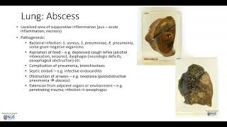 Lung Abscess Gross pathology [upl. by Gyimah]