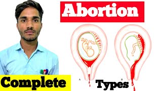 A B O R T I O N  Types Cause Symptoms Diagnosis Treatment  Abortion in Hindi  Types of Abortion [upl. by Ramraj558]