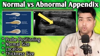 Appendicitis in Ultrasound Appendix Probe Positioning  Appendix Inflammation in Ultrasound [upl. by Alyn]