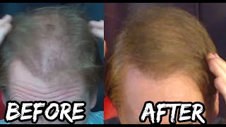 Davids Miracle Hair Loss quotCurequot [upl. by Ayotac830]