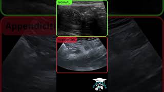 How to Diagnose Appendicitis with Ultrasound Identifying Normal and Pathological Appendix [upl. by Channa]