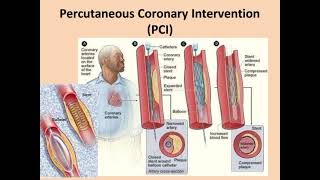 Atherosclerosis Angina Myocardial infarction✨ Full information💯 [upl. by Assirahc]