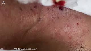 Big Cystic Acne Blackheads Extraction Blackheads amp Milia Whiteheads Removal Pimple Popping [upl. by Drofliw933]