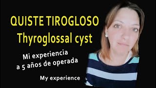 Quiste tirogloso post operatorio 5 años después Thyroglossal cyst 5 years later [upl. by Barclay486]