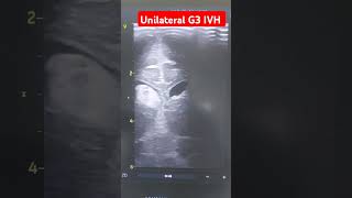 Cranial ultrasound in preterm neonate shows intraventricular hemorrhage G3 neonates hemorrhagic [upl. by Belford563]