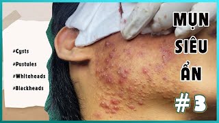 Big Cystic Acne Blackheads Extraction Blackheads amp Milia Whiteheads Removal Pimple Popping [upl. by Ydneh]