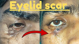 Scar deformity of lower eyelid  Result after surgery Surgery of ectropion of lower eyelideyelids [upl. by Eixela]